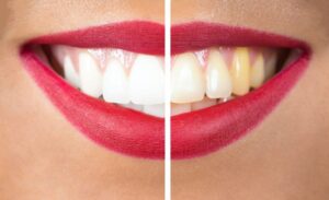 Taking Care of Your Yellow Teeth in Palmdale and Lancaster, California