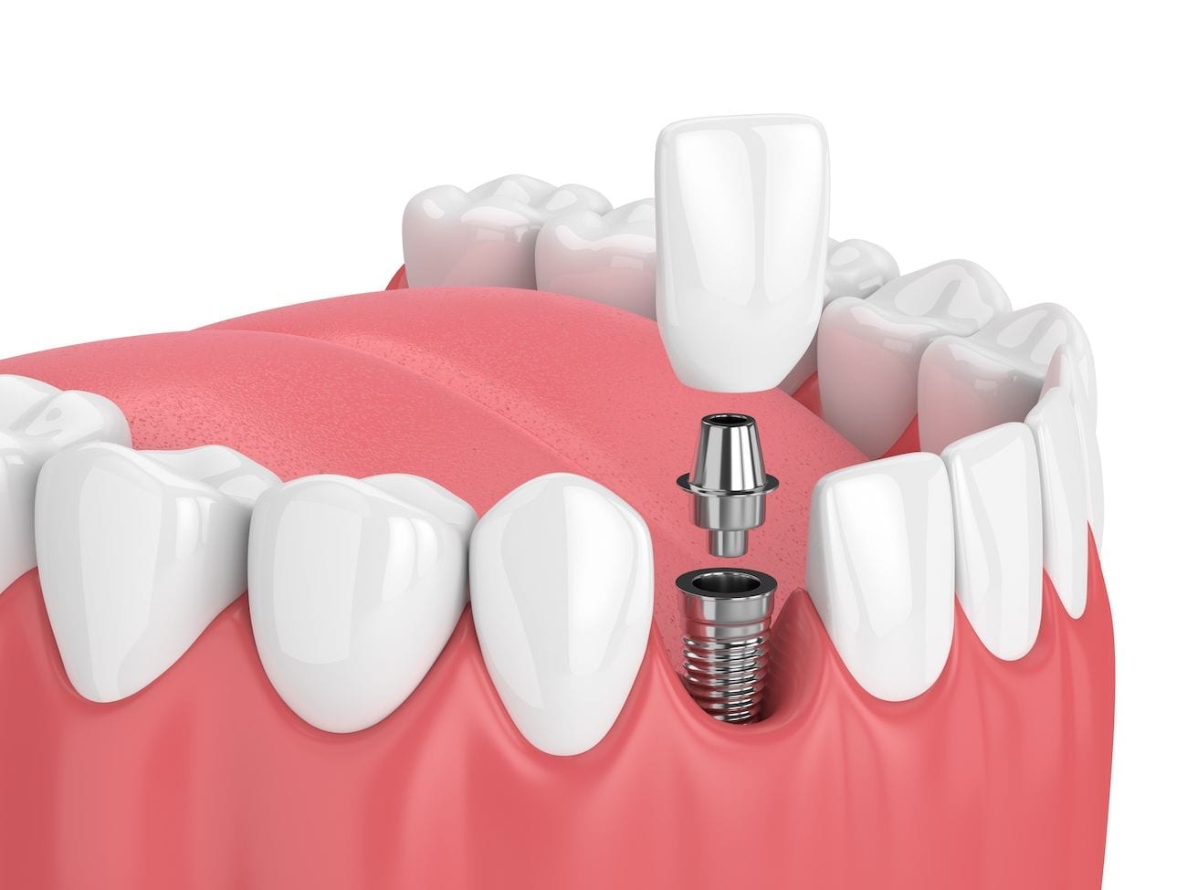Why to Choose Dental Implants Palmdale and Lancaster, CA