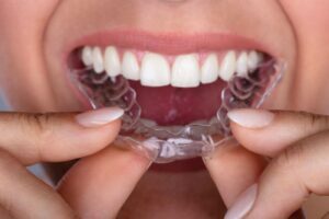 Invisalign in Antelope Valley