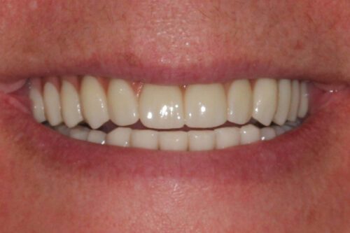 After dentistry at Premier Dental Care