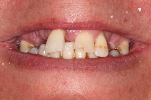 Before dentistry at Premier Dental Care