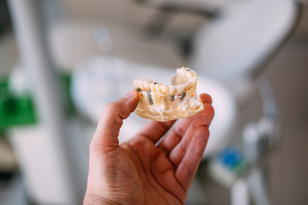 All On X implants in Palmdale and Lancaster California