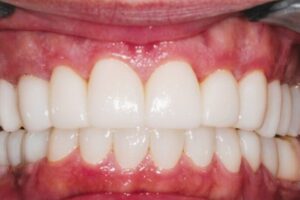 Dental patient after teeth whitening at Premier Dental Care