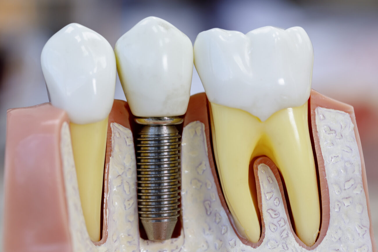 Single Implants in Palmdale, California