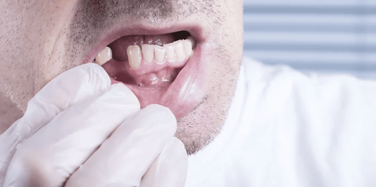 Image of a man with a missing tooth, a gloved hand is pulling down his lip to show the bottom missing tooth tooth extraction dentist in Palmdale California