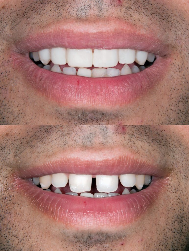 Lumineers in Palmdale and Lancaster, CA can help improve the look of your smile