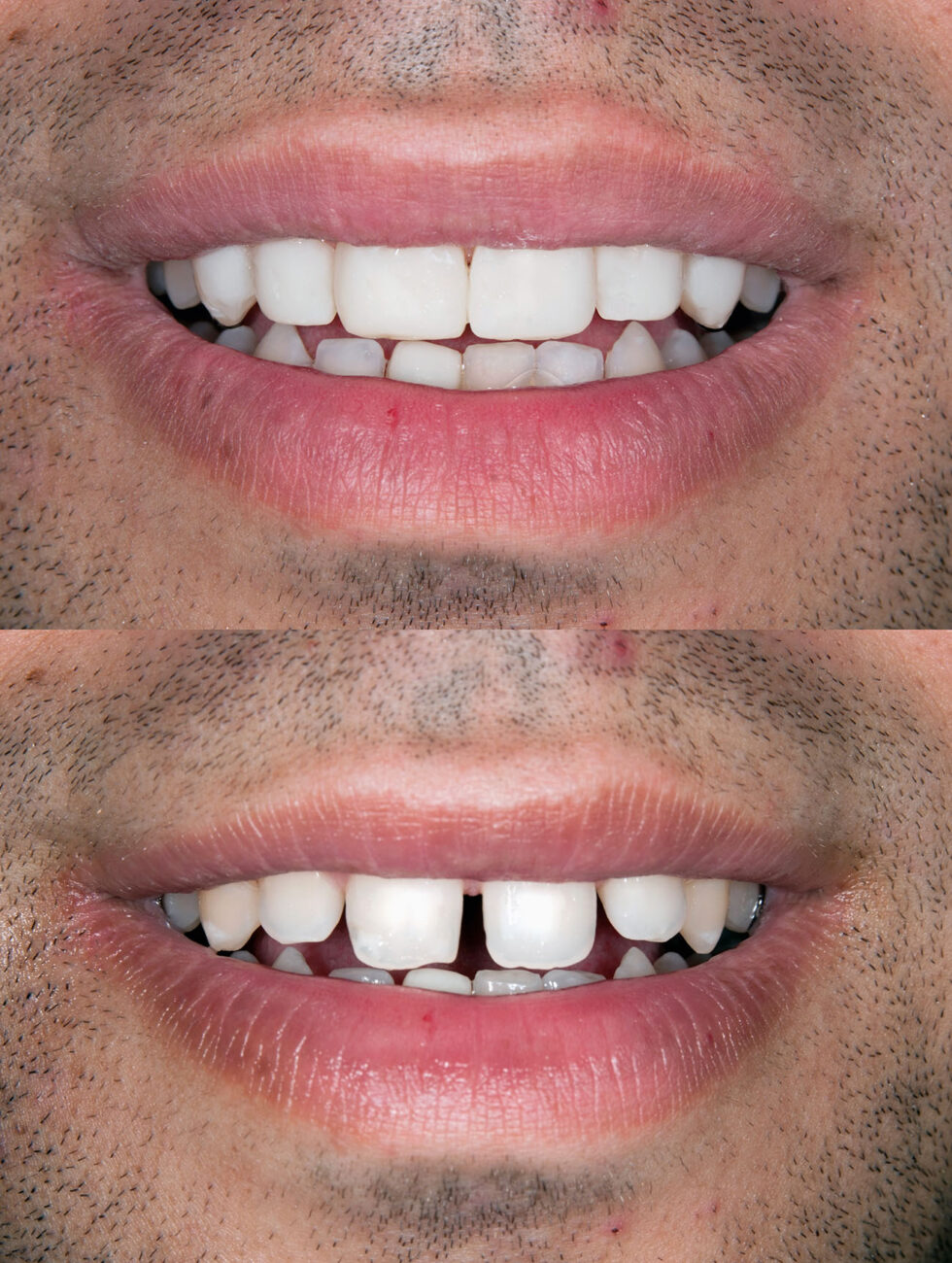 Lumineers Vs. Veneers Premier Dental