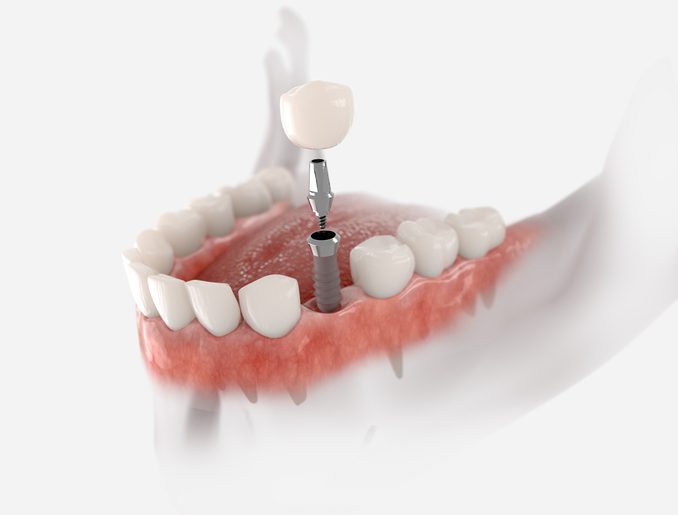 dental implant process in Palmdale, CA