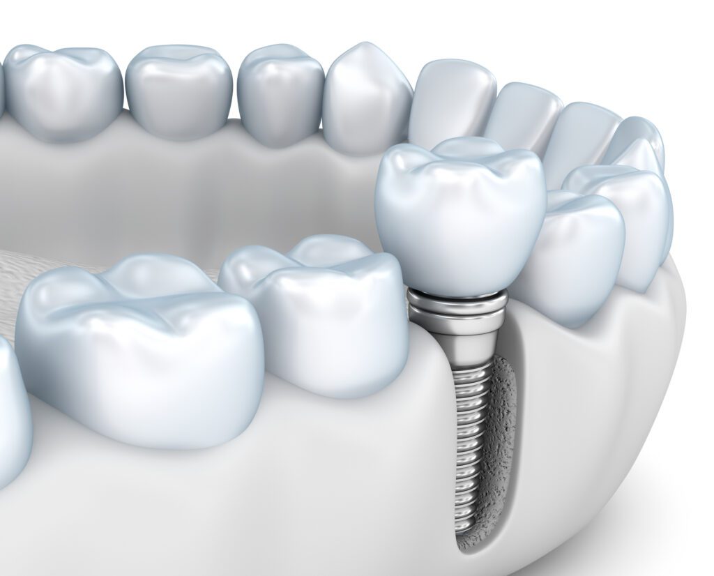 A Single Dental Implant in Palmdale CA can help restore your mouth after losing a tooth