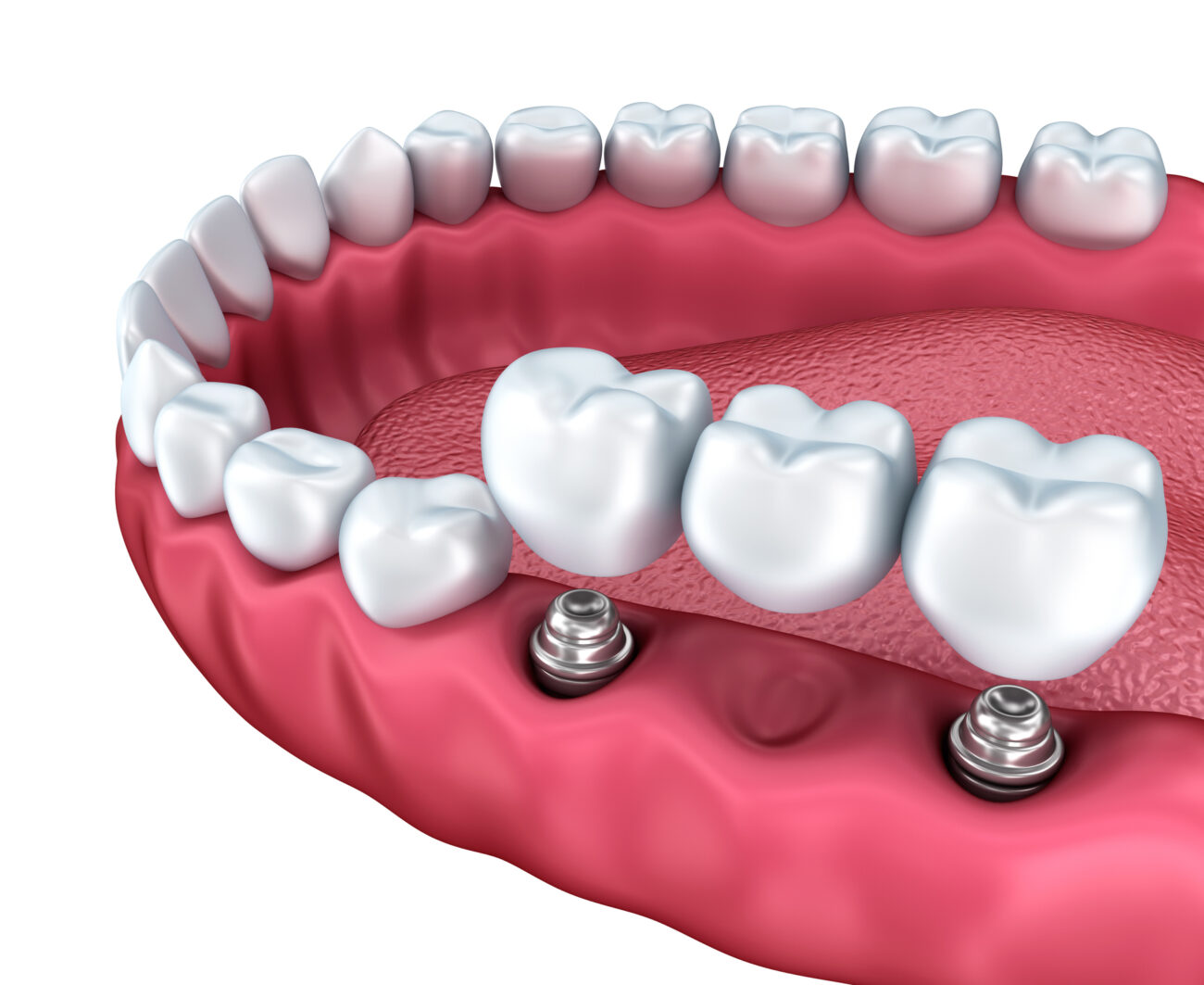 multiple dental implants in Palmdale and Lancaster California