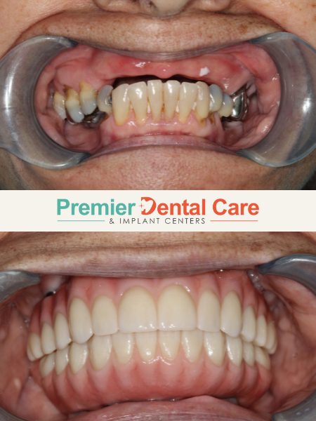 Dental patient before and after replacing missing teeth at Premier Dental Care.