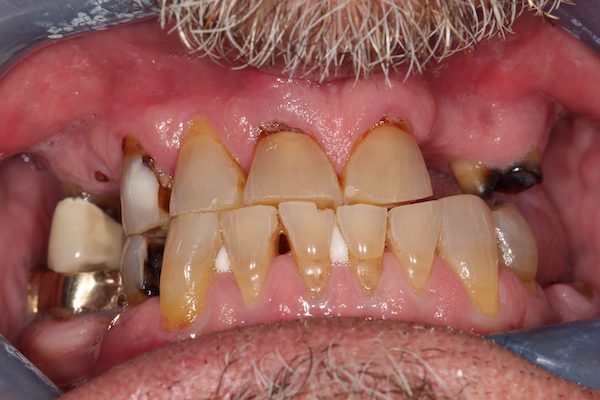 Before dentistry at Premier Dental Care