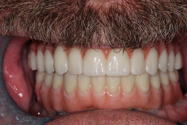 After dentistry at Premier Dental Care
