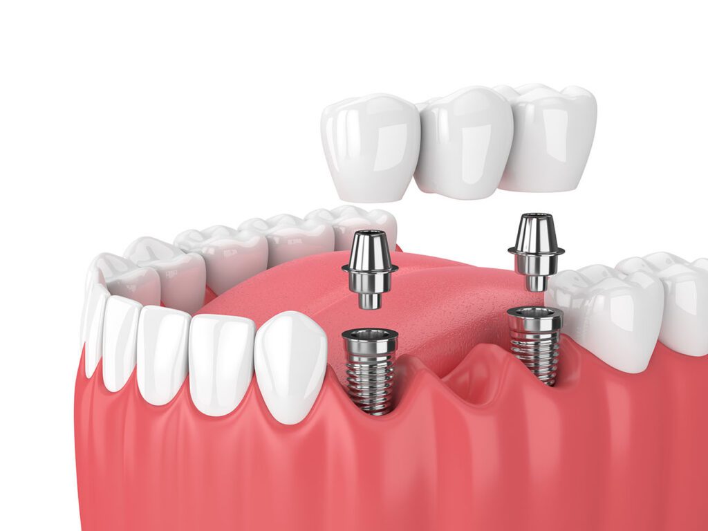 Multiple dental implants offer a solution for those missing several teeth. They could restore both function and aesthetics.