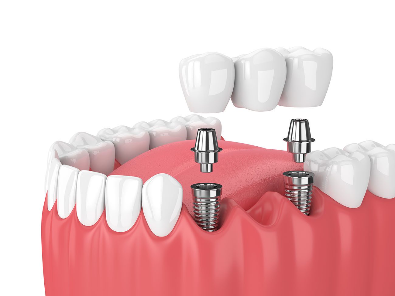 When You Need Multiple Dental Implants Palmdale, CA, Dentist
