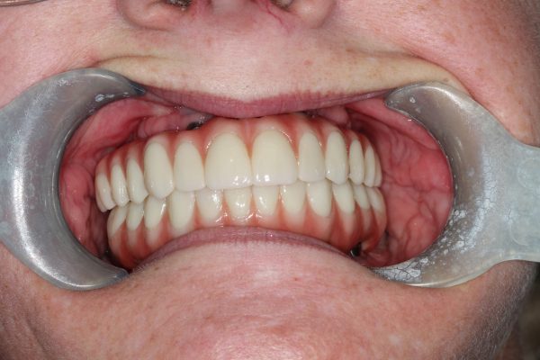After dentistry at Premier Dental Care