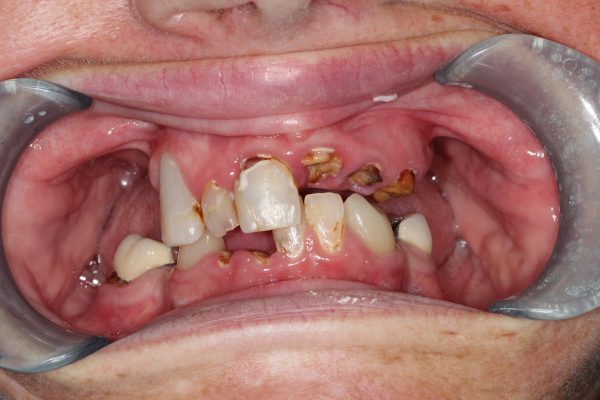 Before dentistry at Premier Dental Care
