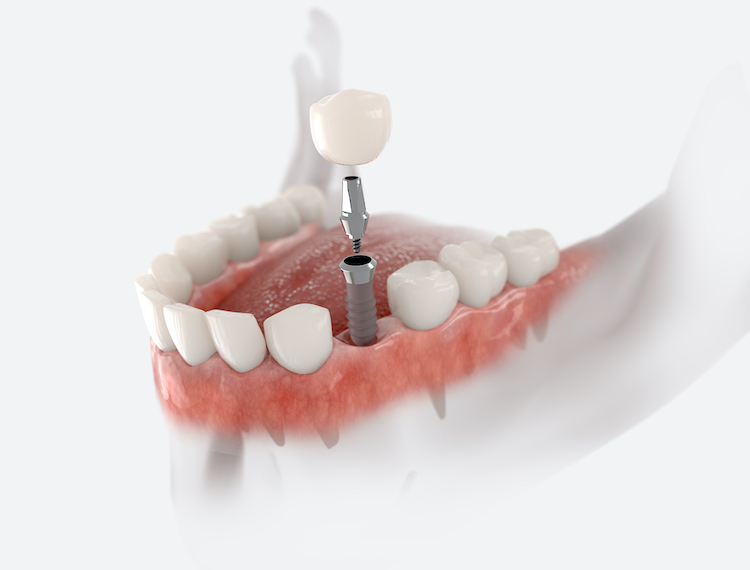 Proper aftercare helps prevent complications and supports the dental implant integration with your jawbone.