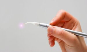 The Benefits of Laser Dentistry Treatment