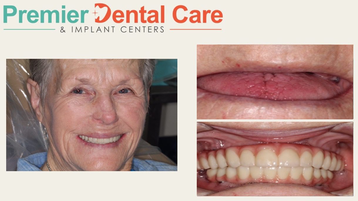 Tommie underwent full mouth reconstruction using all on x for top and bottom teeth.