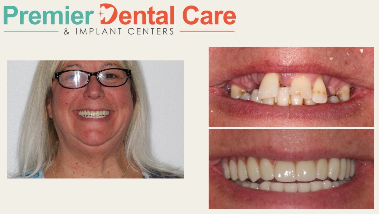 Tracy received an all on X dental implant treatment.
