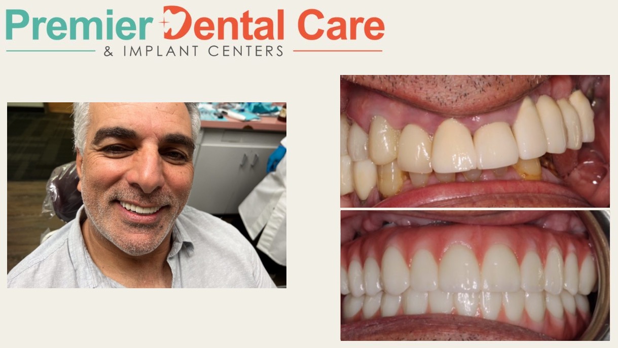 Mark underwent a full mouth rehabilitation using the All-On-X implants method.