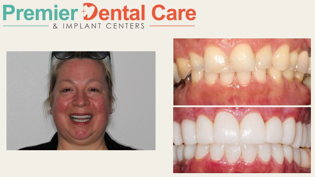 Sandra received a combination of porcelain crowns and bridges combined with implants and bone grafting.