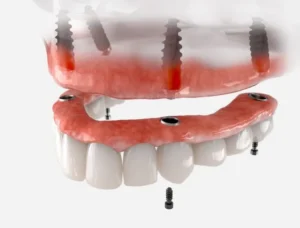A Real Talk About Dental Implants in Palmdale, CA