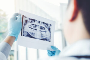 Can I Get Dental Implants in Palmdale, CA If I Have Bone Loss?