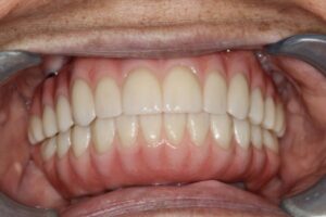 dental patient after full mouth restoration with dental implants