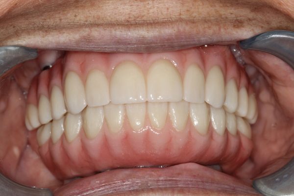 dental patient after full mouth restoration with dental implants