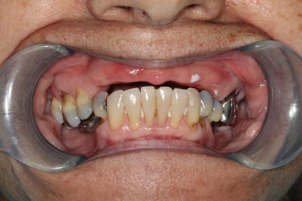 dental patient before full mouth restoration with dental implants