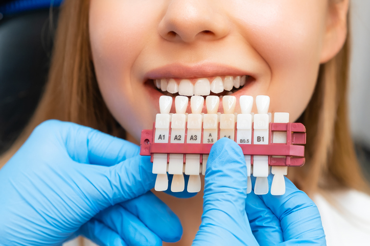 Teeth Whitening vs. Porcelain Veneers: Which Is Right for Your Palmdale Smile?